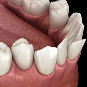 Illustration of crooked teeth