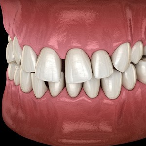 Illustration of gapped teeth