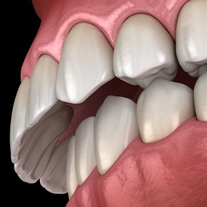 Illustration of an overbite