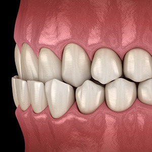 Illustration of an underbite