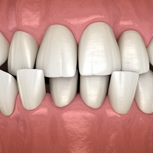 Illustration of a crossbite