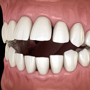 Illustration of an open bite