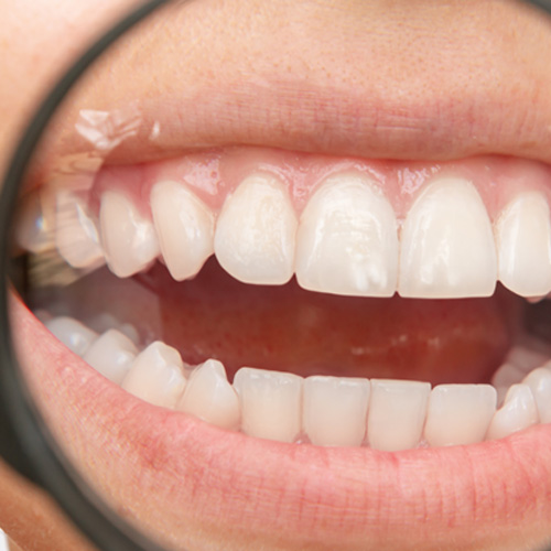 Closeup of fluorosis on teeth