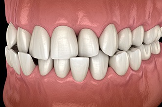 Illustration of a crossbite