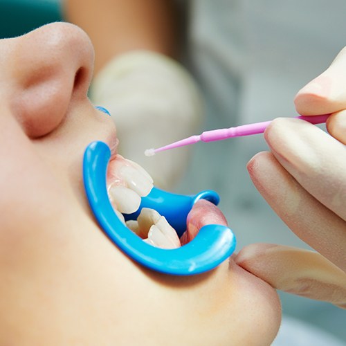 Child receiving fluoride treatment