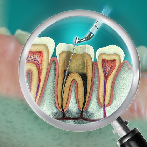 Illustration of instrument being used to perform pulp therapy