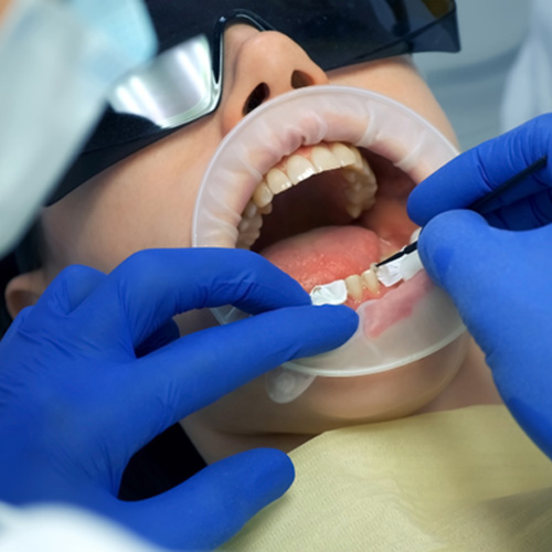 Dentist applying silver diamine fluoride to young girl’s teeth
