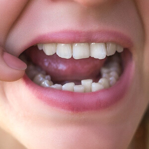 Dentist holding model teeth with traditional braces