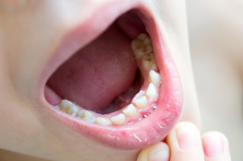 an up-close view of a child who has what is known as “shark teeth” 