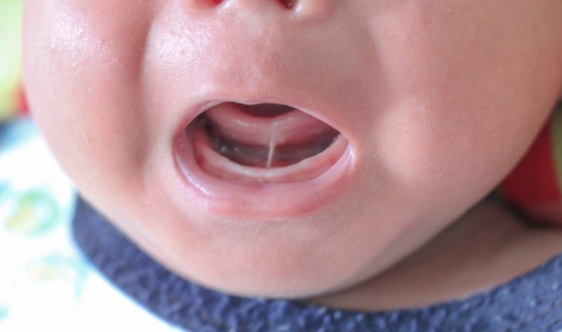 A closeup of a baby with a tongue tie